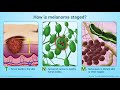 Diagnosing Melanoma