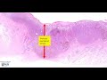 Skin Melanoma Microscopy - Talking slide