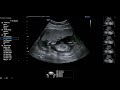 13 weeks pregnancy ultrasound