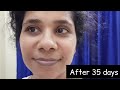 Minimalist Vitamin K under eye cream | Detailed review after 25 days | with live updates