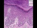 Histopathology Skin--Melanoma in situ