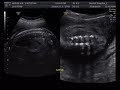fetal ultrasound of 20 weeks 21 weeks baby boy moving