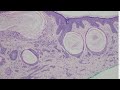 Desmoplastic Trichoepithelioma (benign mimic of skin cancer BCC MAC): Dermpath in 5 Minutes