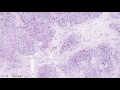 Histopathology - Sarcoidosis of the Skin