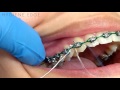 Flossing Braces With a Threader