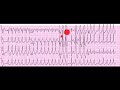 Accessing computerized eye-tracking technology for gaining insight into interpretation of the ECG