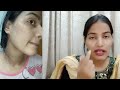 मेरे चेहरे के गड्ढे कैसे भरते है |Dermapen के बाद 5 दिनों में|| 1mm Dermapen Before After Results