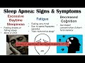 Sleep Apnea Signs & Symptoms (& Why They Occur) | Central, Obstructive & Mixed Sleep Apnea