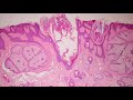 Nevus Sebaceus (not SebaceOus!)...Explained by a Dermatopathologist