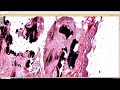 Calcified pilomatrixoma under the microscope (mimic of osteoma cutis calcinosis cutis) dermpath