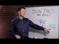 What Causes Skin Tags and Moles? – Dr.Berg