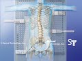 Right Thoracic Curve Scoliosis Providence Nocturnal Scoliosis® System
