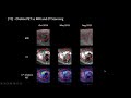 PET Imaging | Eugene Kwon, MD | DIY Combat Manual for Beating Prostate Cancer: Part 1 | PCRI 2021