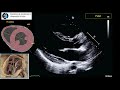 Transthoracic Echo full protocol. Part II: Parasternal View (PLAX , PSAX, RVIT, RVOT, M-Mode)