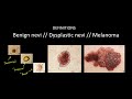 Introduction to Skin Cancer #3: Overview of Nevi and Melanoma