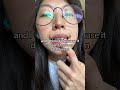 Invisalign: 6th month update | Comparing my first and 37th aligner
