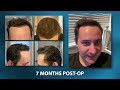 What a Hair Transplant Looks Like - Week By Week