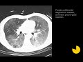 Classic Signs | Chest Radiology Board Review