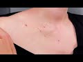 How to Get Rid of Cherry Angiomas Moles (Red Skin Dots) | PLASMA PEN REMOVAL REVIEW + DEMO + RESULTS