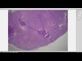 Basic Soft Tissue Pathology Cases: Explained by a Sarcoma Pathologist