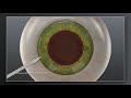 Catalys Laser Cataract Surgery  vs Traditional Manual Cataract Surgery  Animation