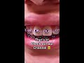 How braces are put on - Tooth Time Family Dentistry New Braunfels