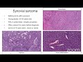 #BSTPATH  Practical Approach  to Sarcomas with Fascicular or Herringbone Architecture