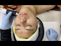 Oxygeneo facial