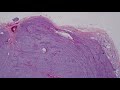 Synovial Sarcoma 101…Explained by a Soft Tissue Pathologist