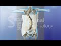 A Scoliosis Double Curve- Providence Nocturnal Scoliosis® Orthosis