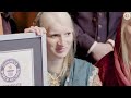 We're Asian, Albino and Beautiful - Guinness World Records
