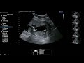 Pregnancy Ultrasound Live