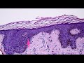 Melanocytic Dermpath Basics: Immunohistochemistry