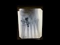 Lisfranc Injury Open Reduction Internal Fixation in Soccer Player