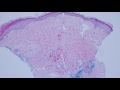 Basic Dermpath Cases  - Explained by a Dermatopathologist