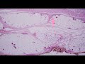 Myxofibrosarcoma 101...Explained by a Sarcoma Pathologist