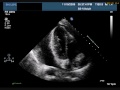 Pericardial Effusion with Tamponade 2 of 2.wmv
