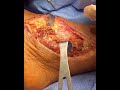 GIANT CELL TUMOR EXCISION | FULL SURGICAL VIDEO AND TECHNIQUE | DR. SARANG DESAI