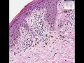 Histopathology Skin--Lentiginous junctional nevus, hypermela