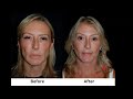 Segmental Endoscopic Brow Lift; a Lower Lid: SOOF lift blepharoplasty,  Deep plane minituck