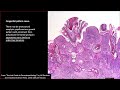 Spitz Nevus, Dysplastic Nevus, Blue Nevus, Congenital Nevus & more - Dermatopathology Basics