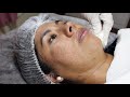 🔴 DERMAPEN | CURSO GRATIS 2021🏆 : Demostración paso a paso Dr. Sergio Zerpa MICRONEEDLING TUTORIAL