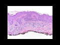 Dermatopathology: The Molecular Basis of Melanoma w/ Dr. Desman