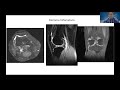 Patologia interna de rodilla y resonancia magnética