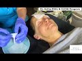 Advanced Brightening Facial with SPICULES (Liquid Microneedling) AO Medical