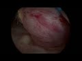 Hysteroscopic polypectomy