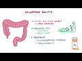 Ulcerative colitis - causes, symptoms, diagnosis, treatment, pathology