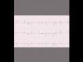 12-lead ECG.avi