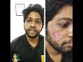 How to remove Acne scare with Dermatrix clinic. #Skinaesthetic #Dermabrasion #bestskinclinicinthane
