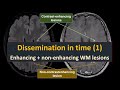 Imaging of Multipe Sclerosis